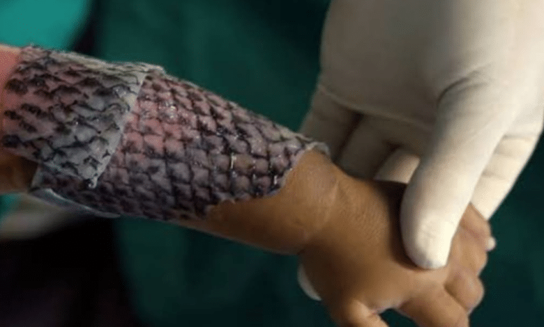 Curan quemaduras con injerto de piel de mojarra en Chiapas