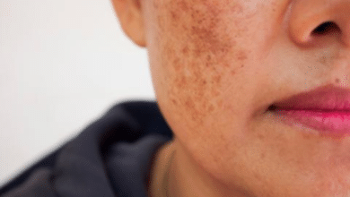 ¿Por qué salen manchas en la cara?