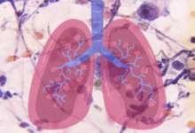 Enfermedades pulmonares las cinco afecciones más comunes en América Latina