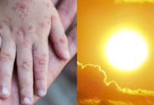 Descartan relación entre ola de calor y aumento de casos del virus Coxsackie en Chiapas