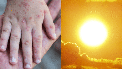 Descartan relación entre ola de calor y aumento de casos del virus Coxsackie en Chiapas