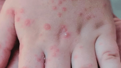 Se dispara el brote del virus Coxsackie en escuelas del Soconusco; suman más de 70 planteles afectados