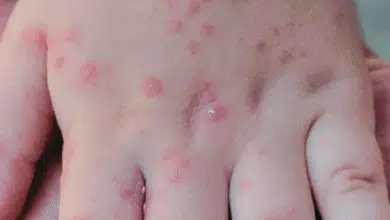 Se dispara el brote del virus Coxsackie en escuelas del Soconusco; suman más de 70 planteles afectados