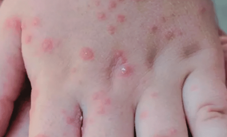 Se dispara el brote del virus Coxsackie en escuelas del Soconusco; suman más de 70 planteles afectados