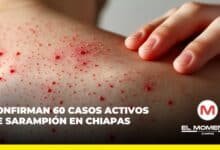 Confirman 60 casos activos de sarampión en Chiapas
