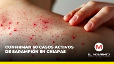 Confirman 60 casos activos de sarampión en Chiapas