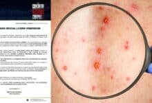 Por sarampión suspenden el 1er Congreso Internacional de Negocios Chiapas