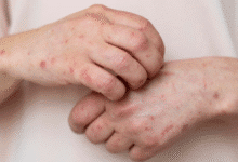 Sarampión en Chiapas: Diferentes organizaciones alerta sobre brote activo en Tuxtla Gutiérrez