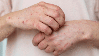 Sarampión en Chiapas: Diferentes organizaciones alerta sobre brote activo en Tuxtla Gutiérrez