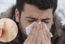 Síntomas y contagio del sarampión: ¿Cuánto tiempo tarda en manifestarse el virus?