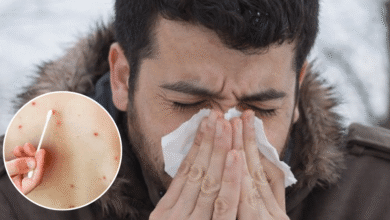 Síntomas y contagio del sarampión: ¿Cuánto tiempo tarda en manifestarse el virus?