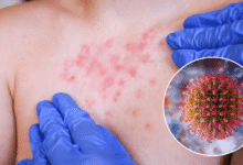 OPS emite alerta epidemiológica por brote de sarampión; México lidera casos en América