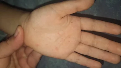 Alertan por casos de virus mano, pie y boca en escuelas; llaman a reforzar medidas de higiene
